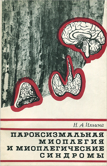 Пароксизмальная миоплегия и миоплегические синдромы